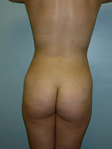 Liposuction before and after - after
