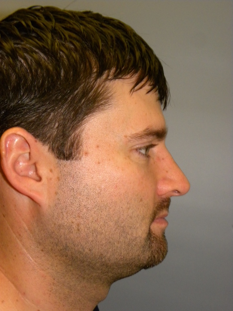 Liposuction before and after - after