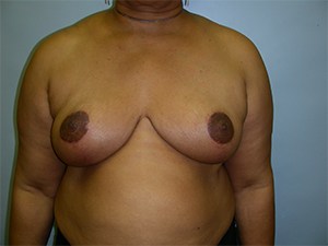 Breast Reduction before and after - after