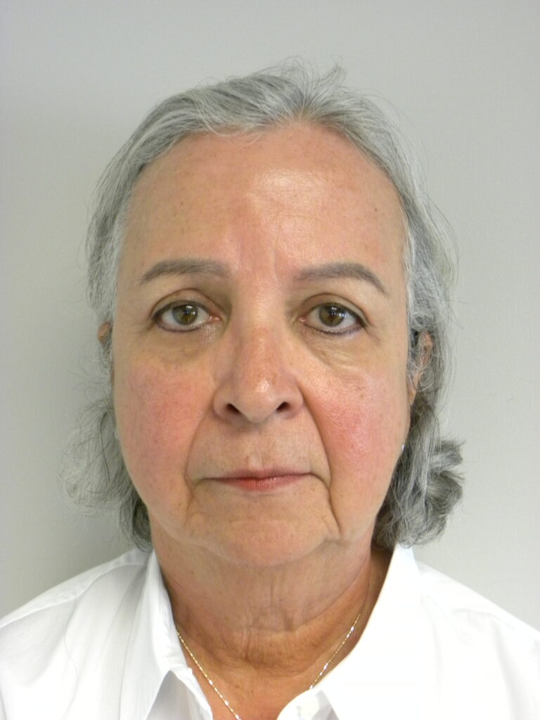 Blepharoplasty before and after - after