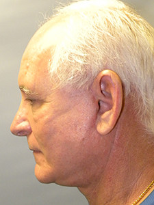 Facelift before and after - after