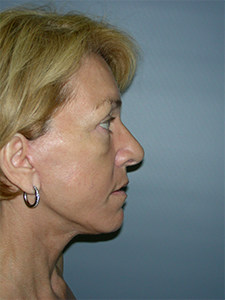 Facelift before and after - after
