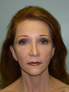 Facelift before and after - after