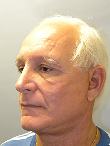 Facelift before and after - after