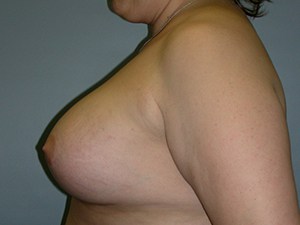 Breast Augmentation before and after - after