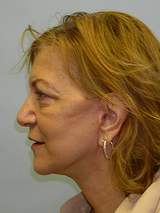 Facelift before and after - after