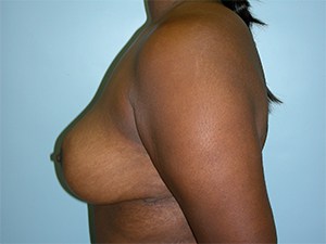 Breast Reduction before and after - after