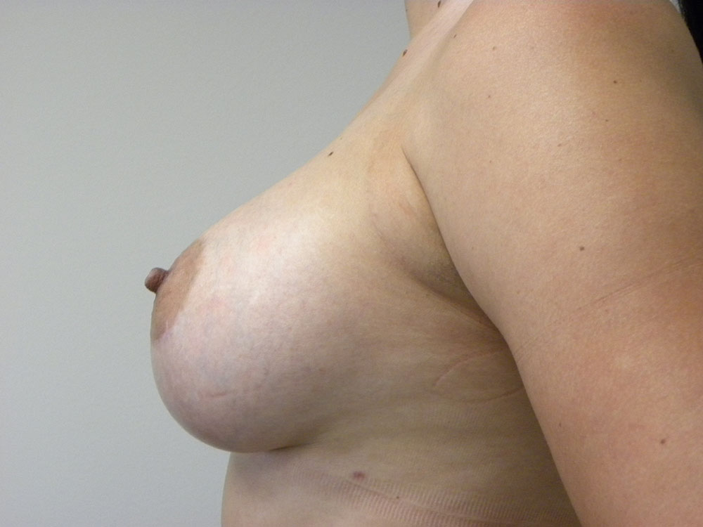 Breast Augmentation before and after - after