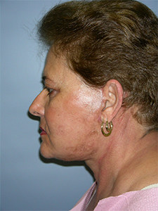 Facelift before and after - after