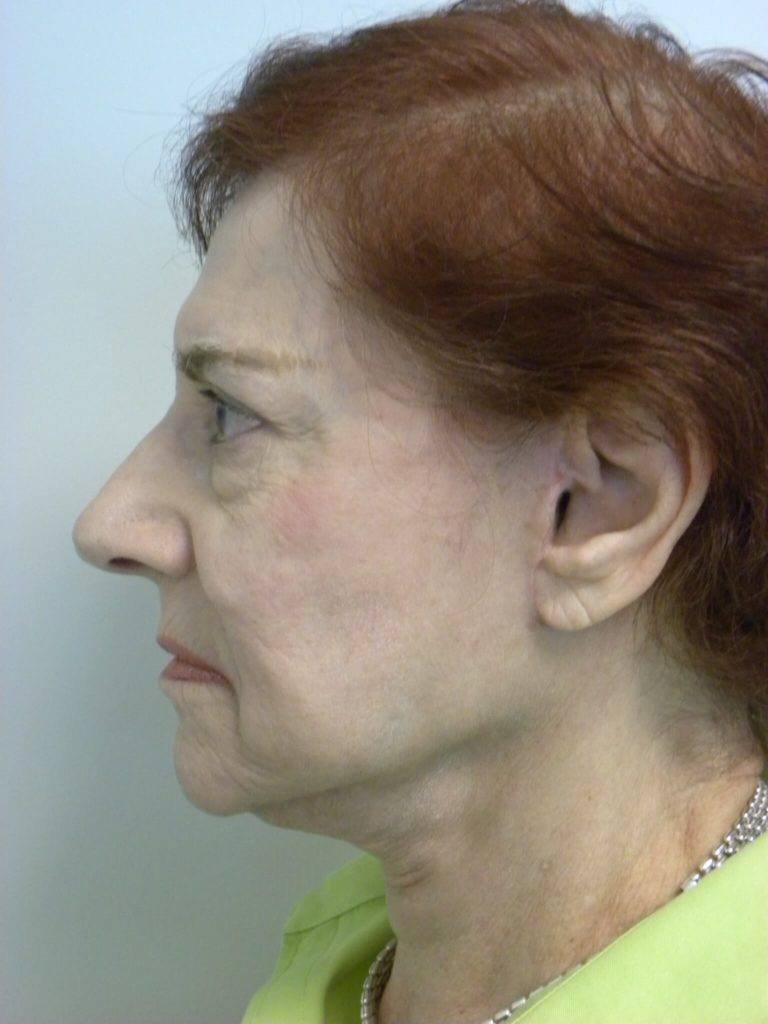 Facelift before and after - after