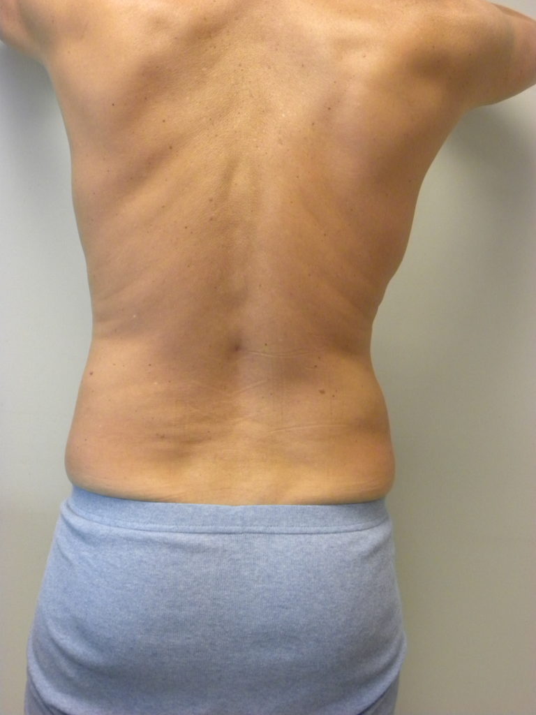 Liposuction before and after - after