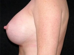 Breast Augmentation before and after - after