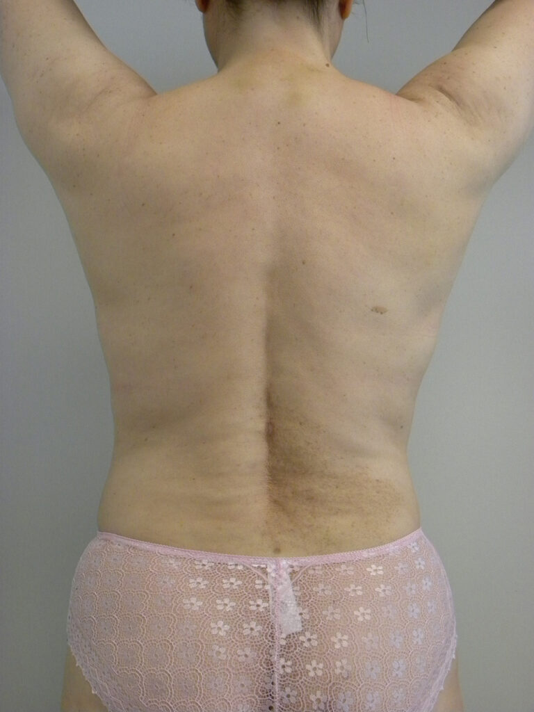 Liposuction before and after - after