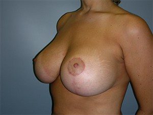 Breast Lift before and after - after
