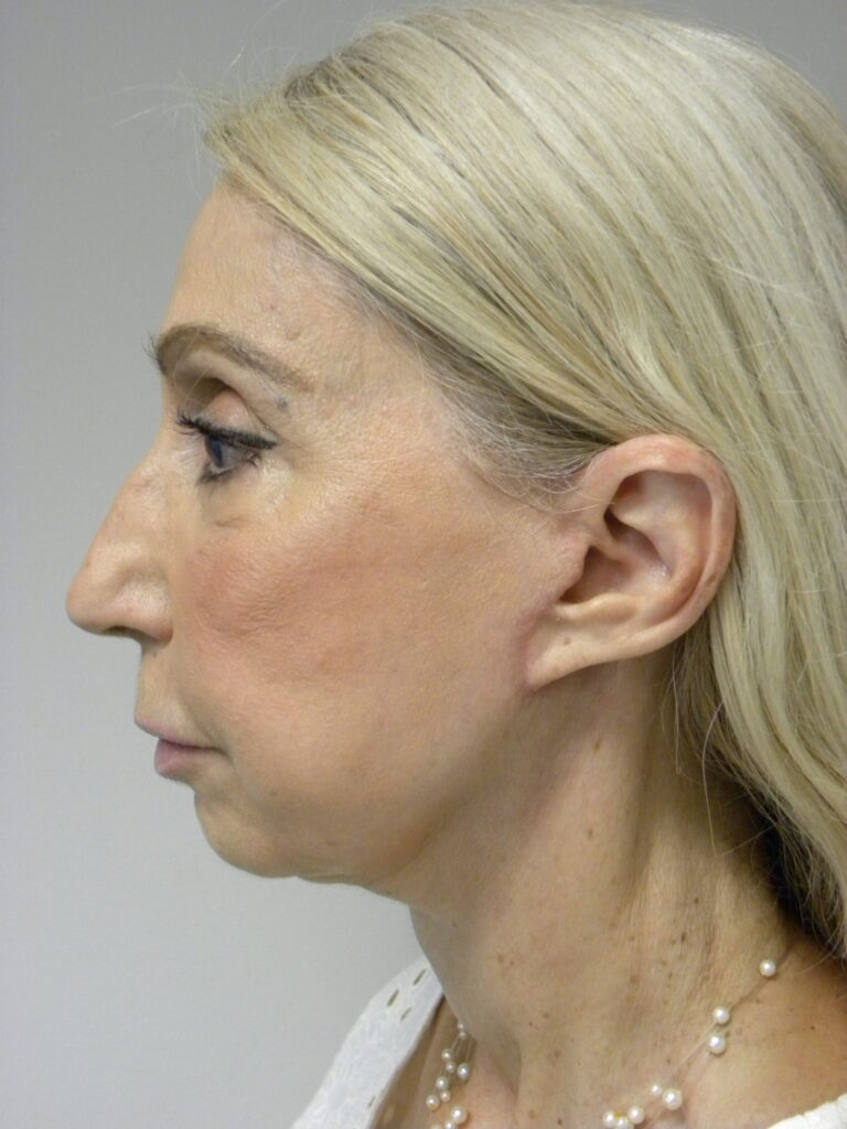 Facelift before and after - after