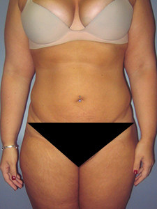 Liposuction before and after - after