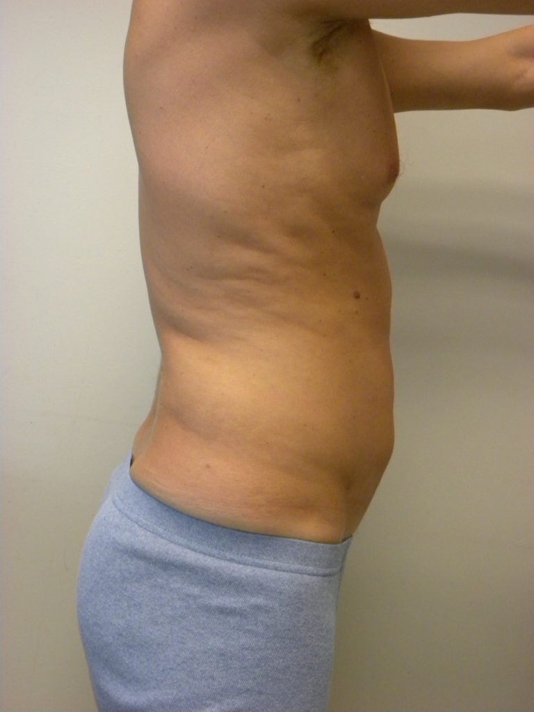 Liposuction before and after - after