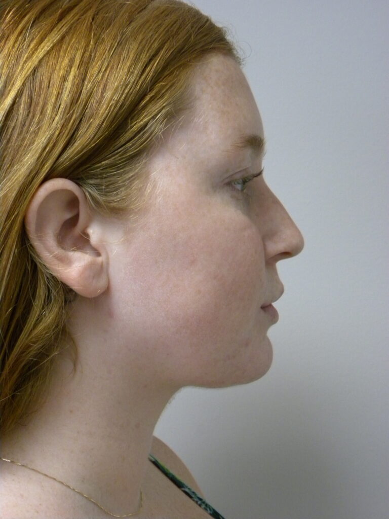 Chin before and after - after