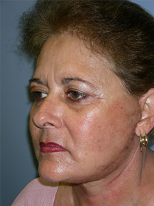 Facelift before and after - after