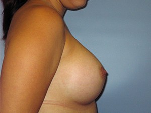 Breast Augmentation before and after - after