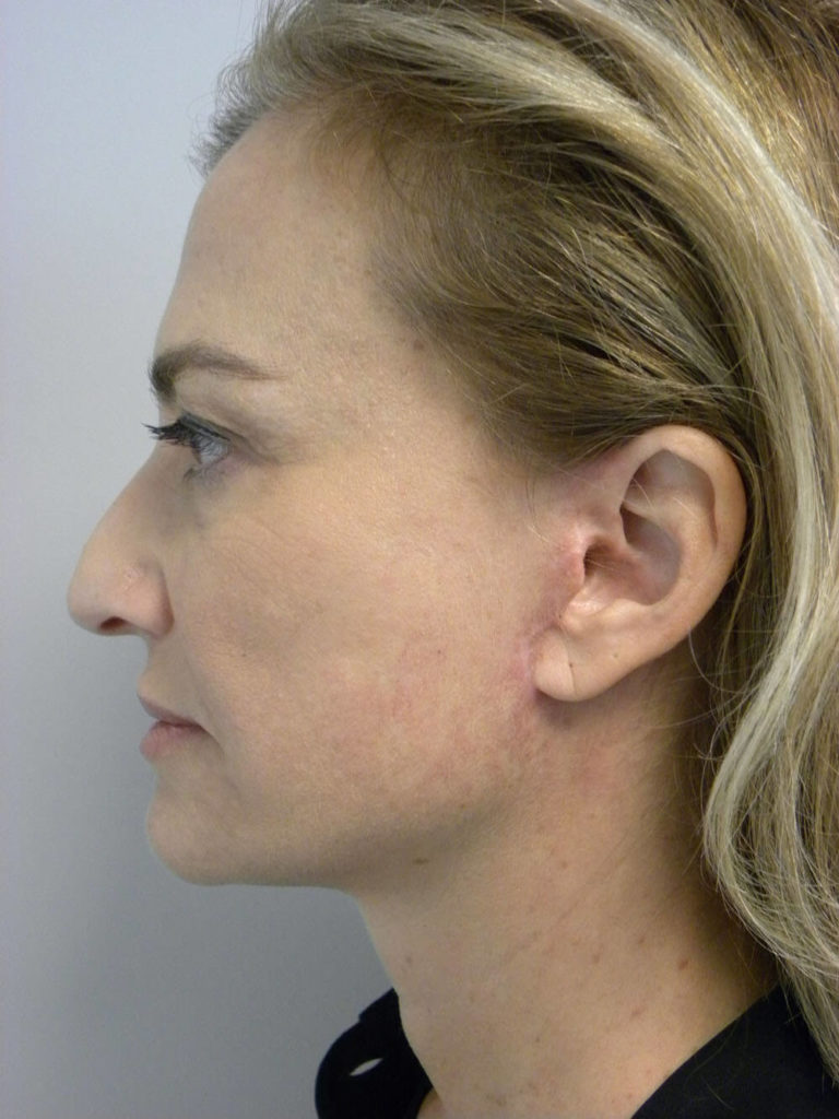 Facelift before and after - after