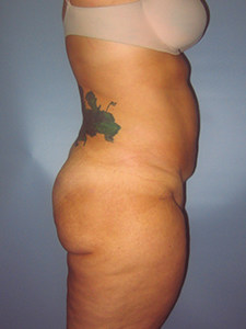 Liposuction before and after - after
