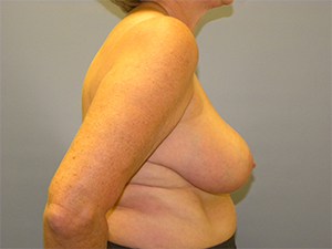 Breast Reduction before and after - after