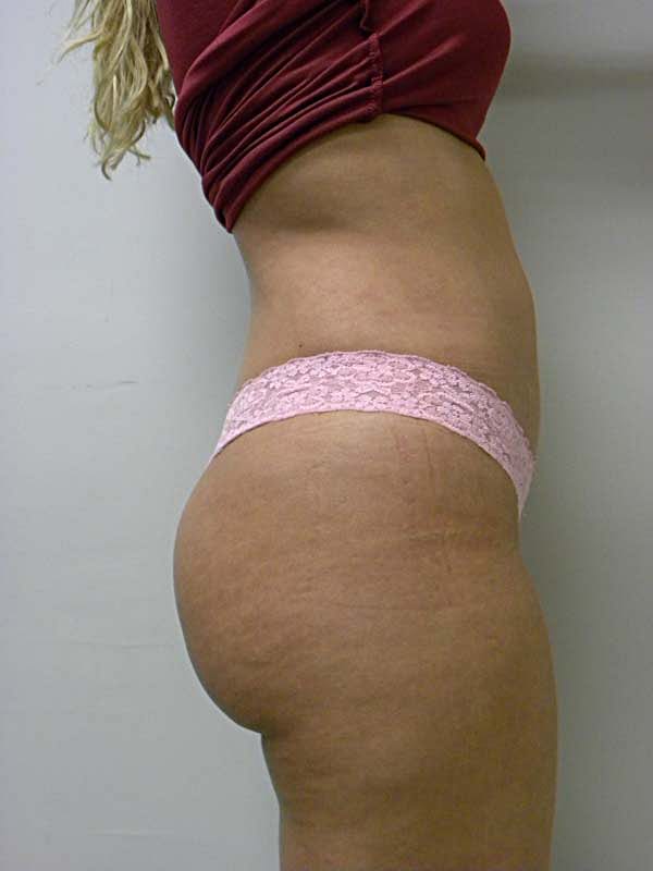 Liposuction before and after - after