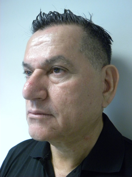 Facelift before and after - after