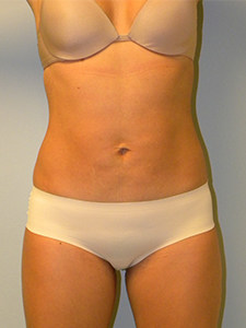 Liposuction before and after - after