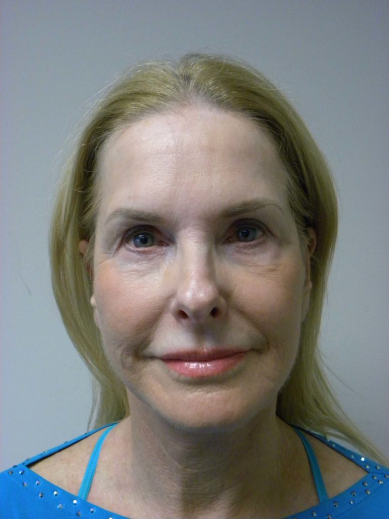 Facelift before and after - after