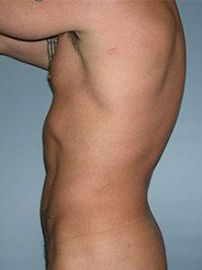 Liposuction before and after - after