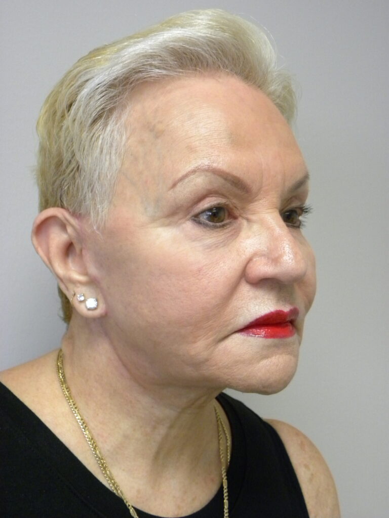 Facelift before and after - after