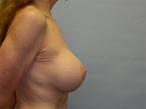 Breast Augmentation before and after - after