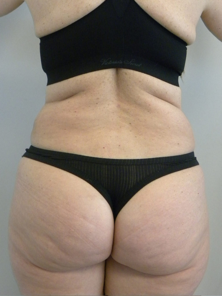 Liposuction before and after - after