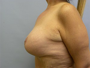 Breast Lift before and after - after