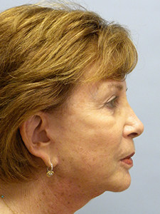 Facelift before and after - after