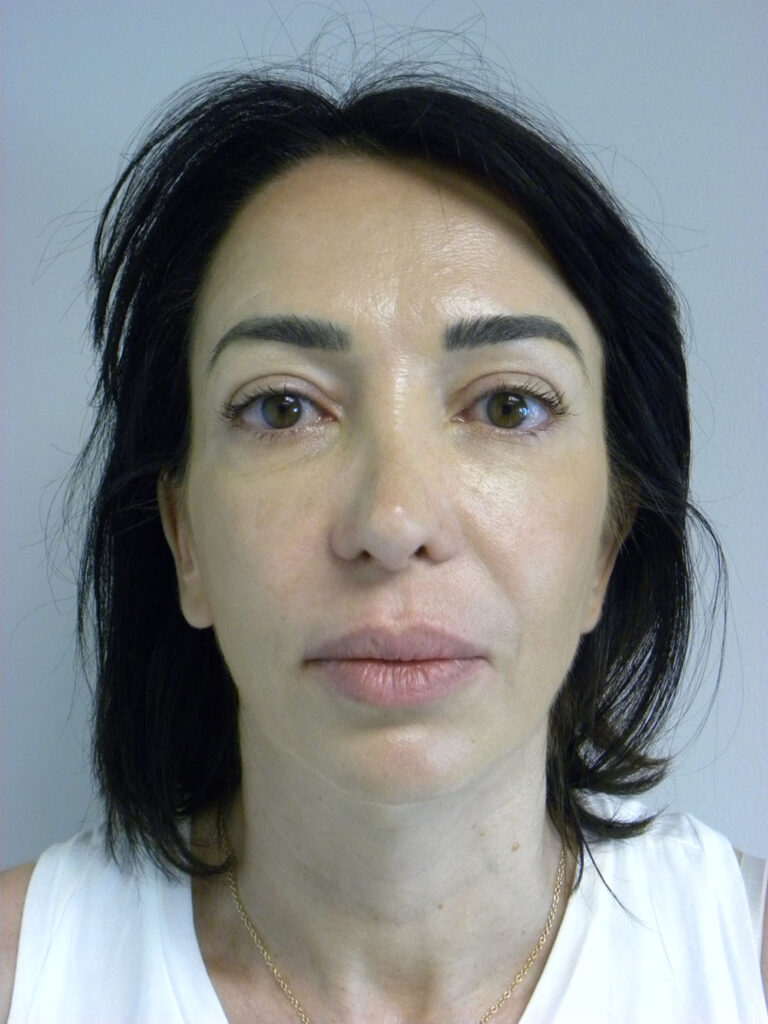 Blepharoplasty before and after - after