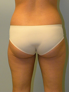 Liposuction before and after - after