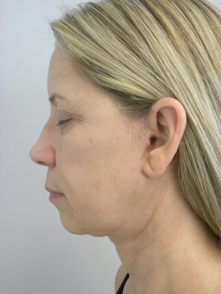 Facelift before and after - after