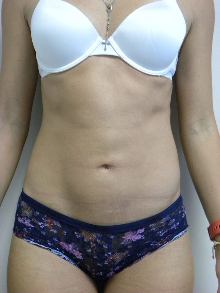 Liposuction before and after - after