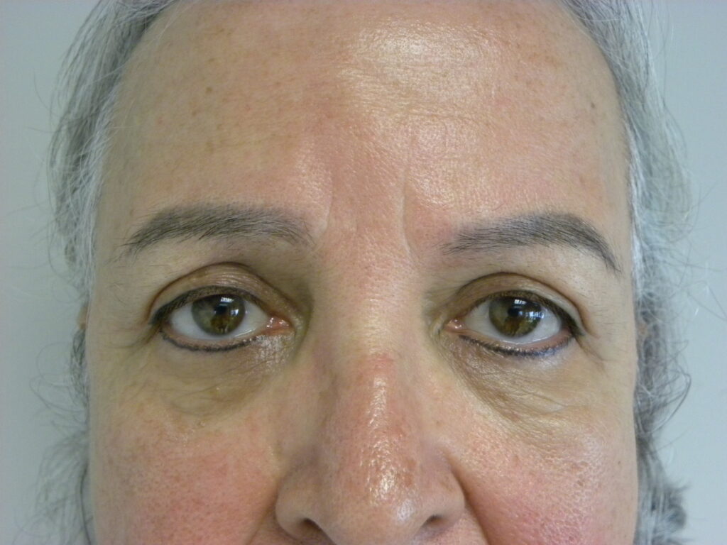 Blepharoplasty before and after - after