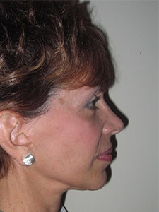 Facelift before and after - after