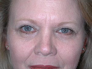 Blepharoplasty before and after - after