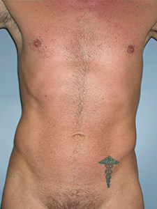 Liposuction before and after - after