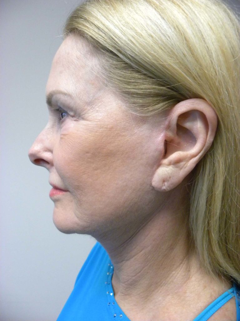 Facelift before and after - after