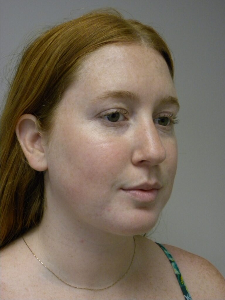 Chin before and after - after