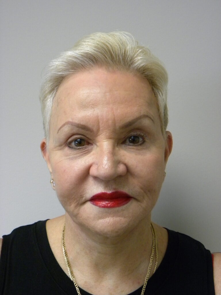 Facelift before and after - after