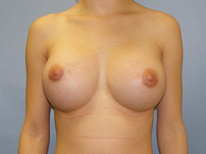 Breast Augmentation before and after - after