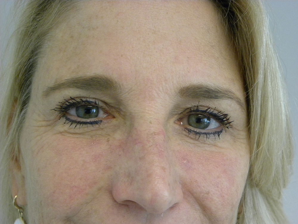Blepharoplasty before and after - after